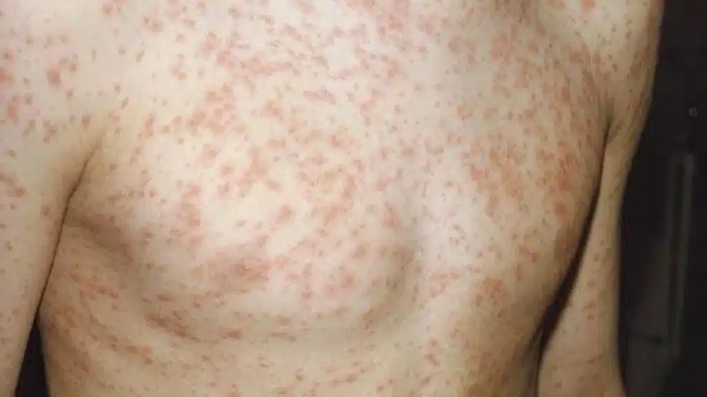 Measles Case in Ireland