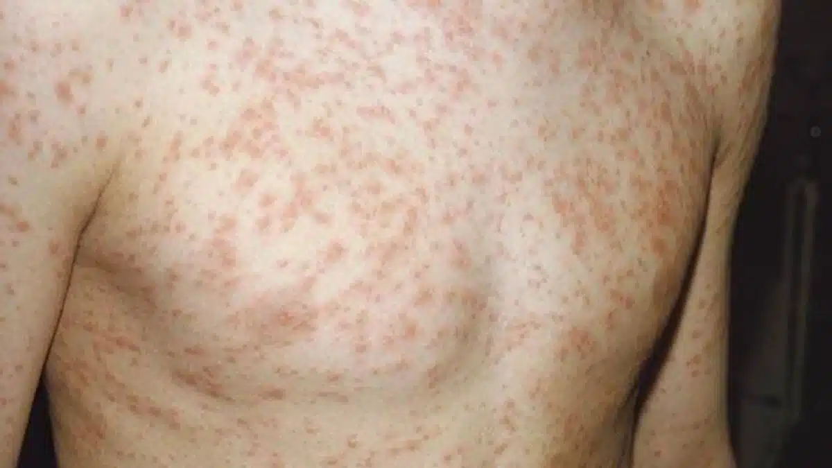 1st Confirmed Measles Case of 2024 Ends in Death in Ireland Measles Case in Ireland