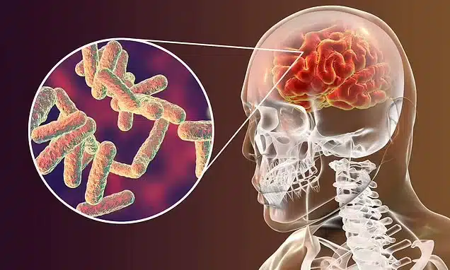 Meningitis Warning from Burns school