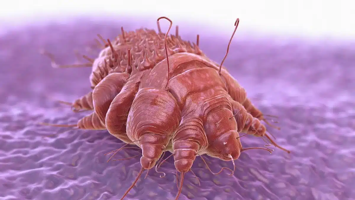 Scabies Outbreak in Ireland
