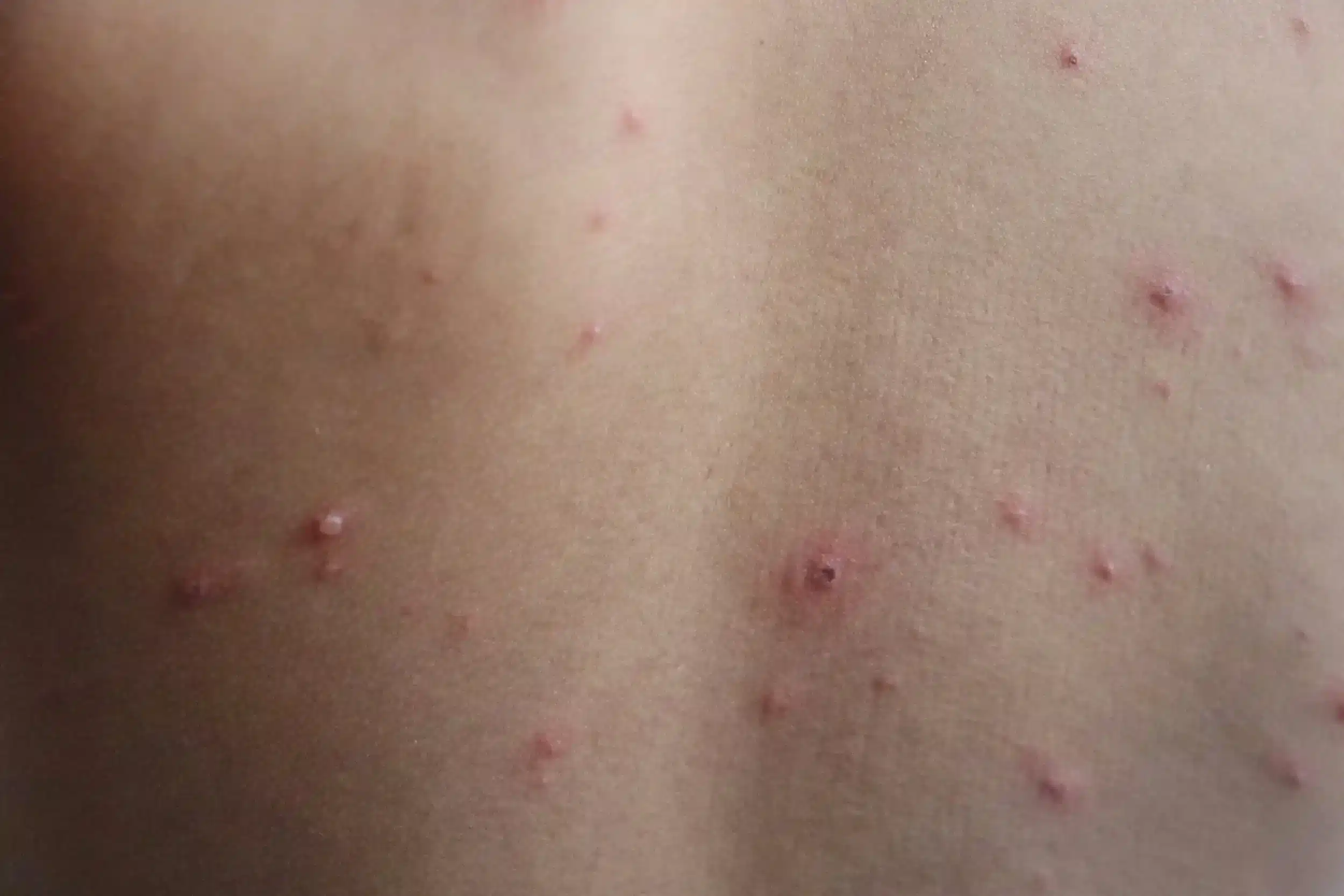 Measles Outbreak on Abu Dhabi-Dublin Flight, HSE Warns Measles Outbreak