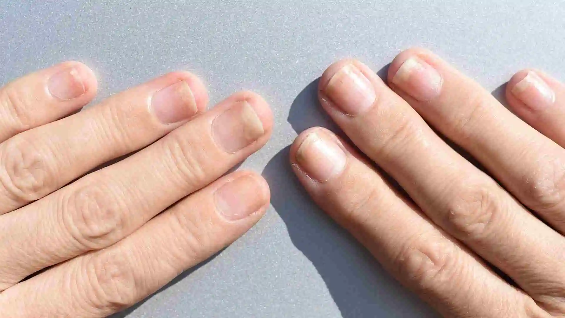 fungal nail infection